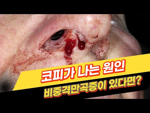 코피나는 원인은 크게 2가지 입니다