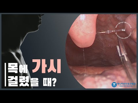 내 목에 가시 – 가시 빼는 법