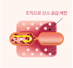 노화하거나 문제가 생긴 혈관 모식도 — 조직으로 산소 공급이 제한된 상태
